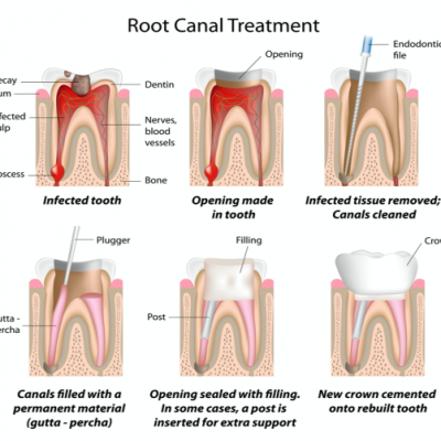 Root canal